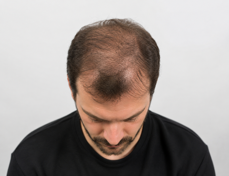 PRP hair restoration in san diego