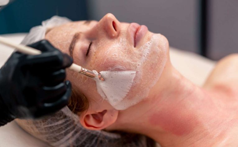 Chemical Peels treatment