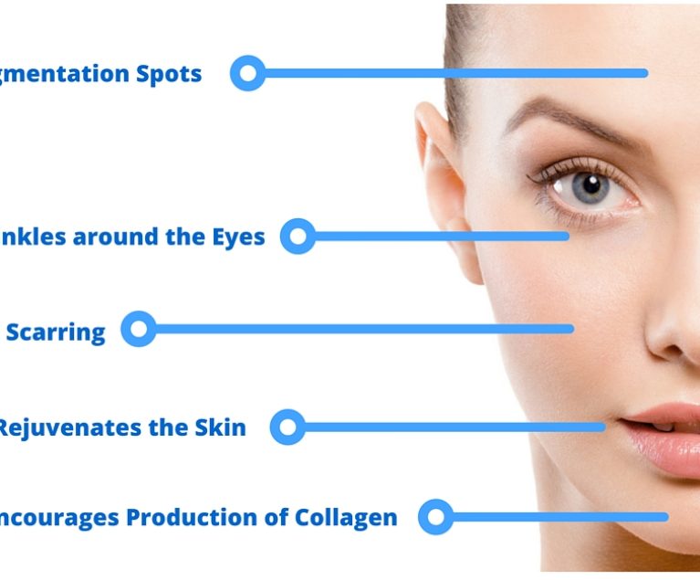 Micro-needling-CIT-Diagram